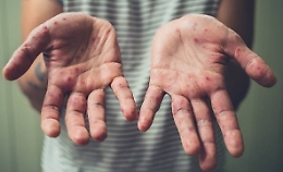 Allarme morbillo in Sicilia: incidenza di casi pi&ugrave; alta d'Italia