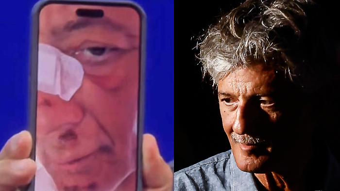 «Atterro di faccia»: la caduta (autoironica) di Fiorello in bicicletta, il racconto dal palco e la foto delle ferite